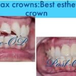 E-Max esthetic Crown, E-Max crowns price India