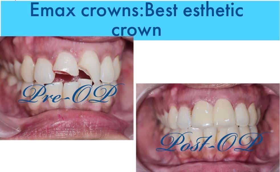 E-Max esthetic Crown, E-Max crowns price India
