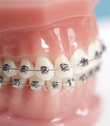 Dental Braces Treatment in Ahmedabad at Chandkheda  