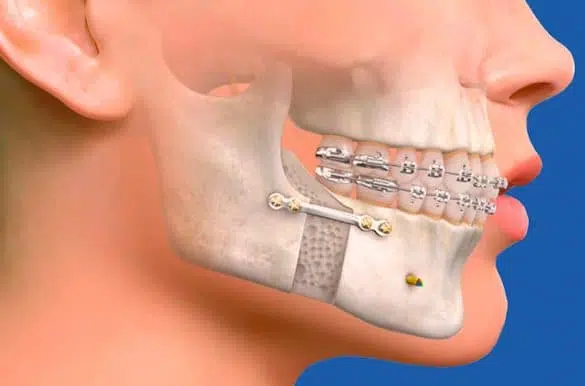 Jaw Fracture Surgery in Ahmedabad  