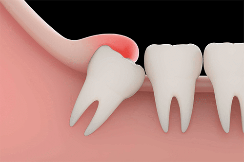 Wisdom Teeth Removal in Ahmedabad  