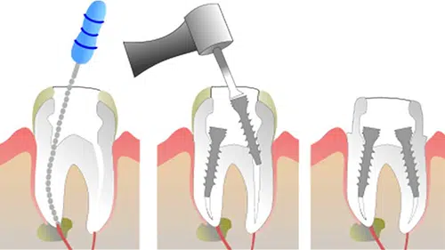 Advanced Root Canal Treatment in Chandkheda Dentist: Best dental clinic in Ahmedabad | Cosmetic dentistry in Chandkheda Dentist: Best dental clinic in Ahmedabad | Cosmetic dentistry in Chandkheda