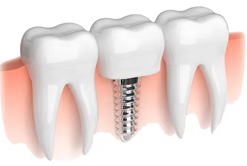Dental Implant Treatment in Ahmedabad at best price  