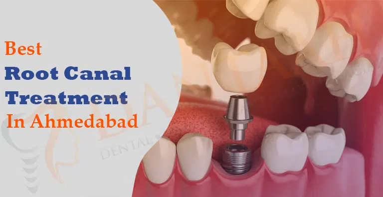 Best Root Canal Treatment In Ahmedabad  