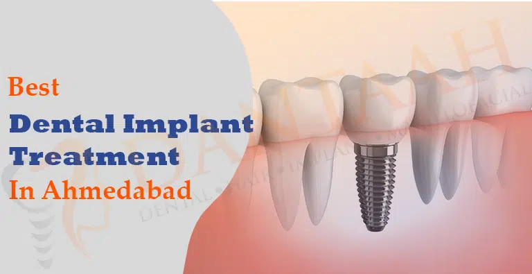 Dental Implant Treatment in Ahmedabad