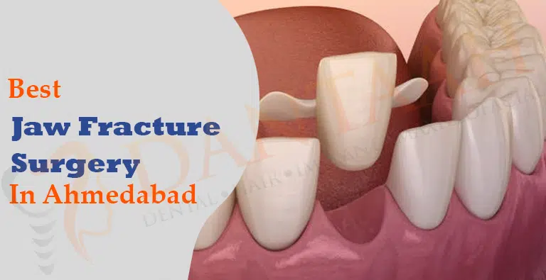 Jaw Fracture Surgery In Ahmedabad  