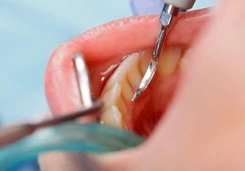 Advanced root canal treatment in chandkheda  