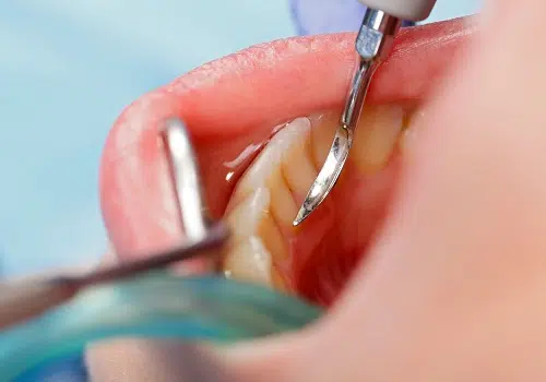 Advanced root canal treatment in chandkheda  