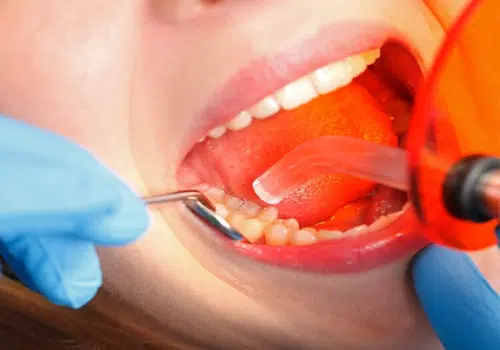 painless root canal treatment in ahmedabad  