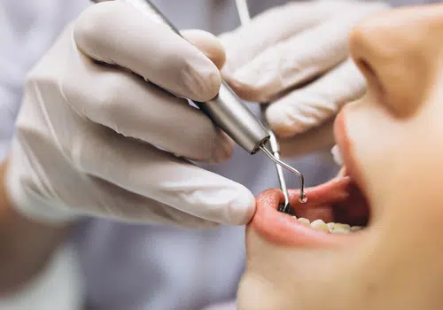 Painless Wisdom Tooth Removal in Ahmedabad  