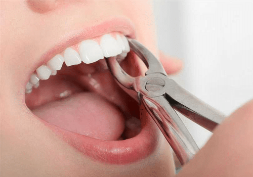 Painless Wisdom Tooth Surgery in Ahmedabad  