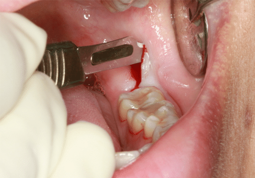 wisdom teeth surgery in chandkheda  