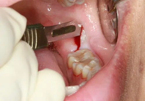wisdom teeth surgery in chandkheda  