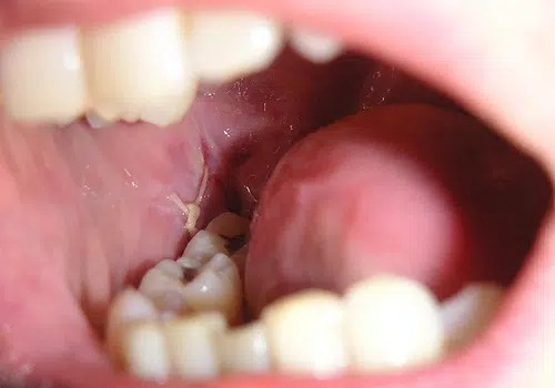 wisdom tooth removal cost in chandkheda  