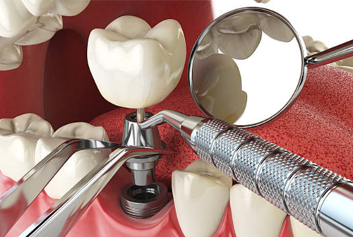 dental-implant-treatment-in-ahmedabad