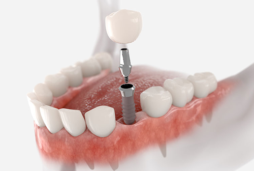 dental implant treatment